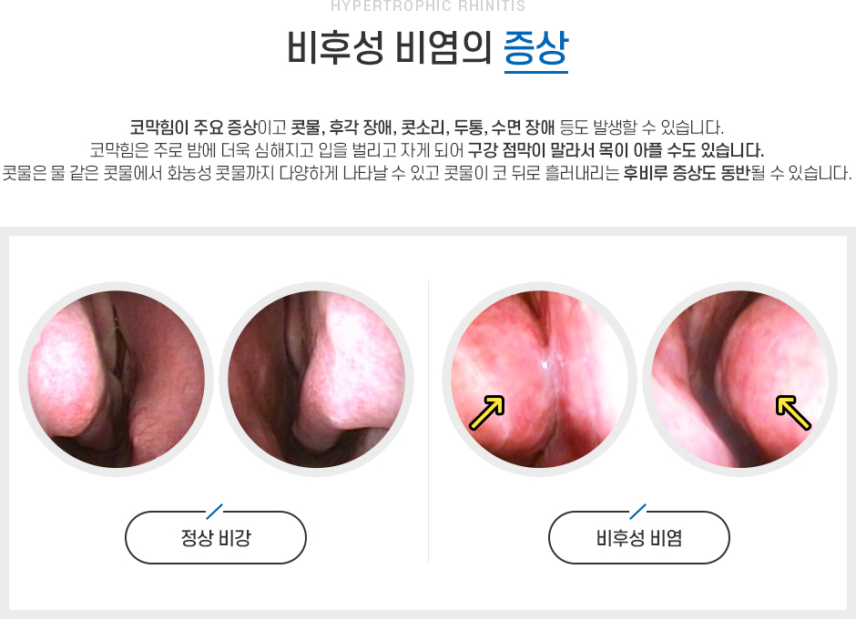 비후성비염 증상