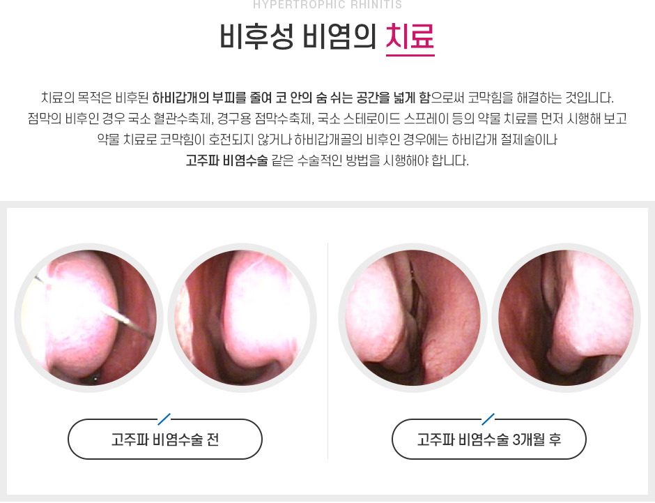 비후성비염 치료