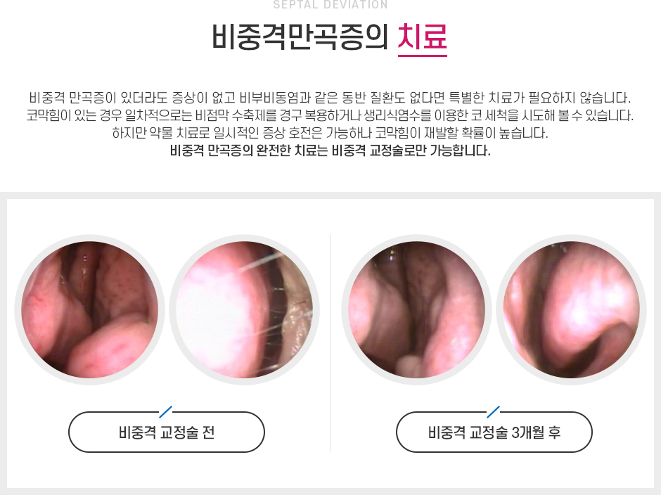 비중격만곡증 치료